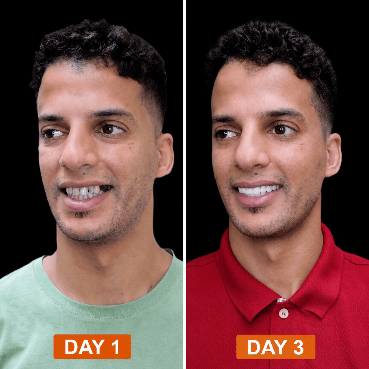 Patient smile transformation at Cosmodent India