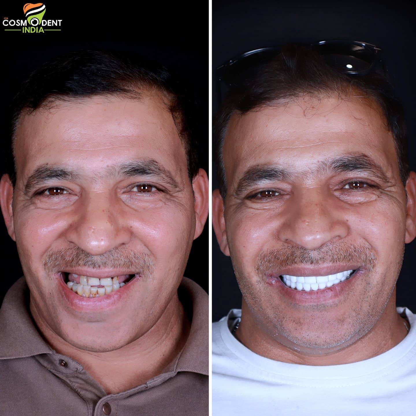 Patient smile transformation at Cosmodent India