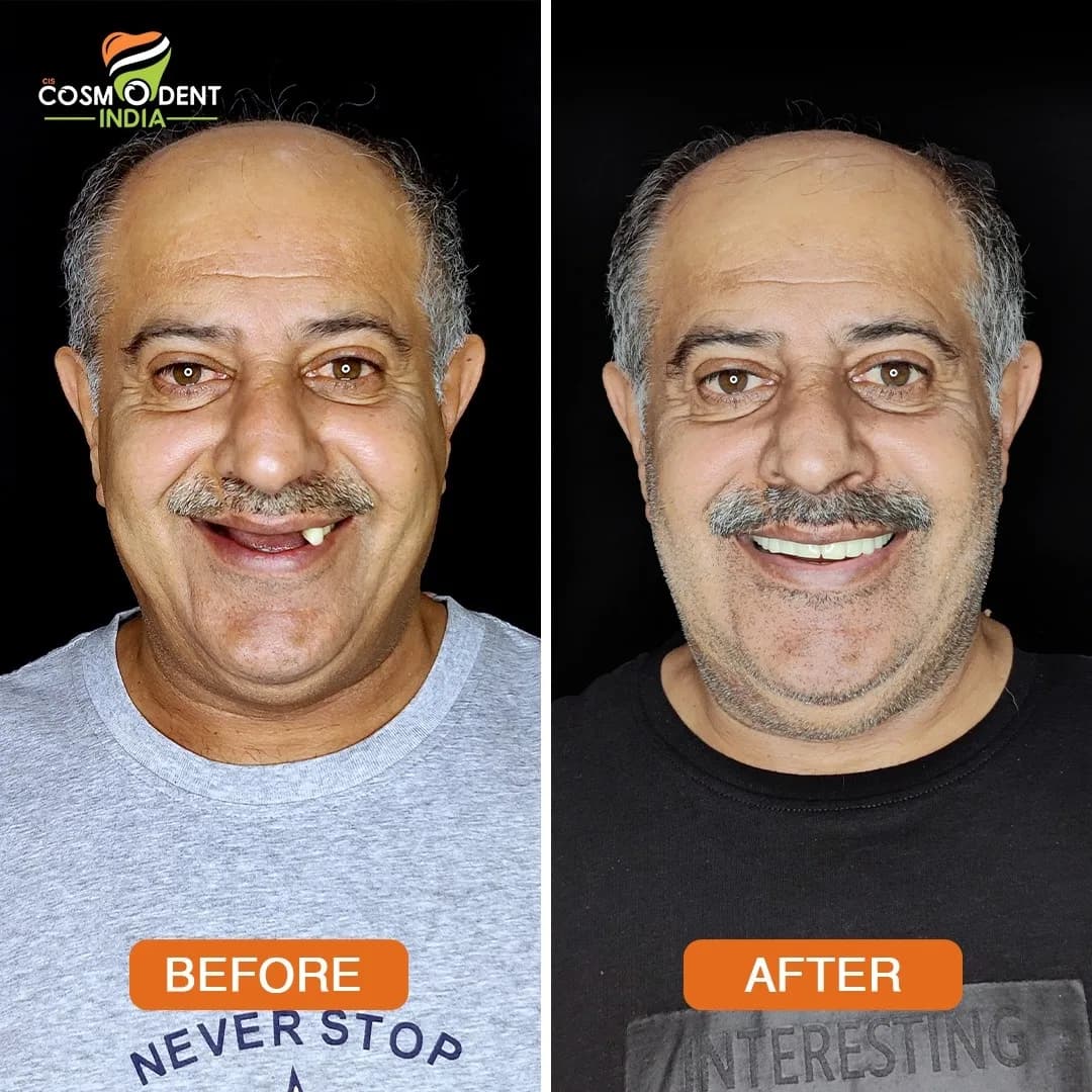 Patient smile transformation at Cosmodent India