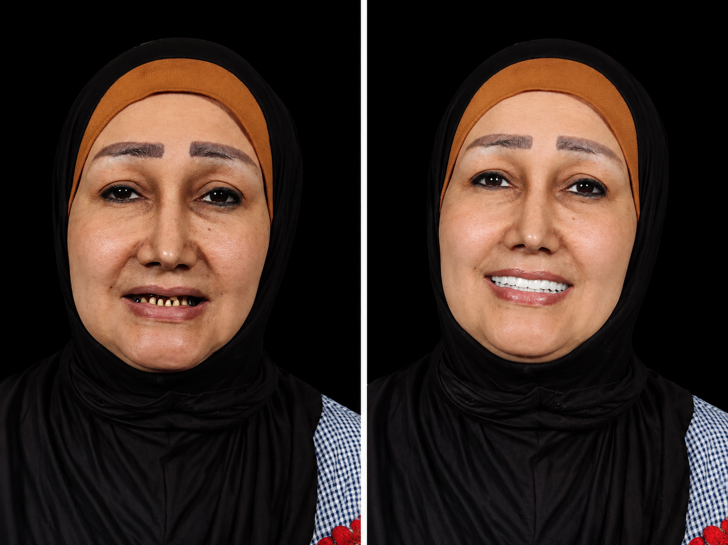 Cosmodent India before and after result 4